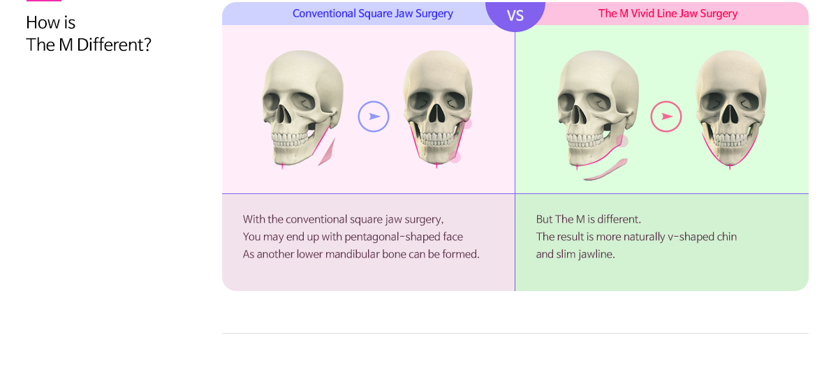 기존 사각턱수술 VS 디엠 Vivid LIine 턱수술, 어떤점이 다를까요 기존 사각턱 수술의 경우 하악각만 짧게 절골할 경우 자연스러운 하악각이 소실되고 (개턱 현상) 2차 하악각이 발생하여 오각형의 얼굴이 될 수 있습니다. 디엠 Vivid Line 턱수술의 경우 S라인 하악각 절제와 함께 하악각에서 턱끝까지 한 번에 하나의 라인으로 길게 절골하여 자연스러운 하악각과 갸름한 V라인을 완성할 수 있습니다.